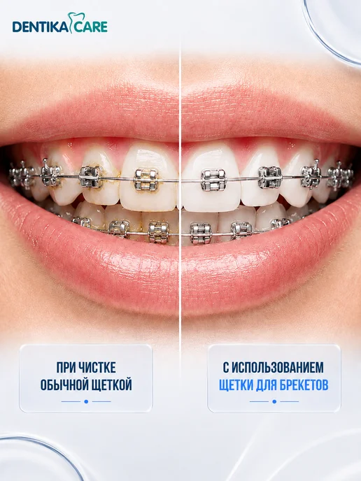 Dentika Care Монопучковая щетка зубная для брекетов монопучок, набор 3шт, 2 шт, фото 4