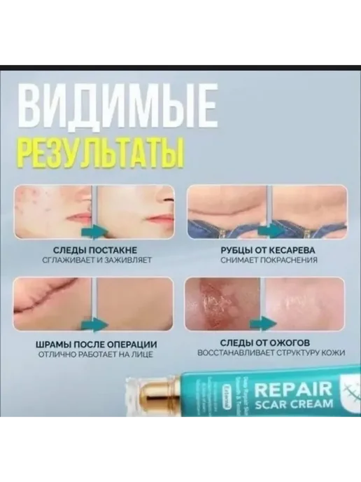 GG Адвент Новый год Крем Гель от шрамов рубцов постакне мазь от ожогов, вариант, фото 5