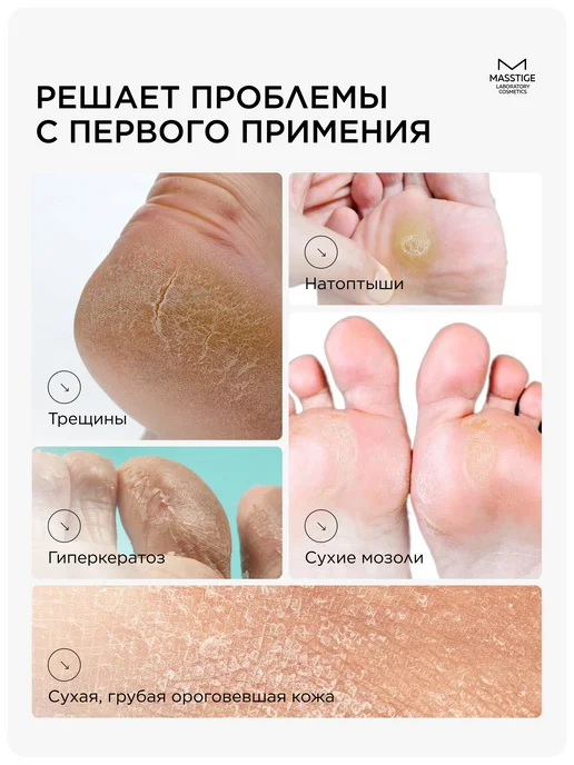 MASSTIGE Кератолитик для пяток против натоптышей с мочевиной, вариант, фото 2